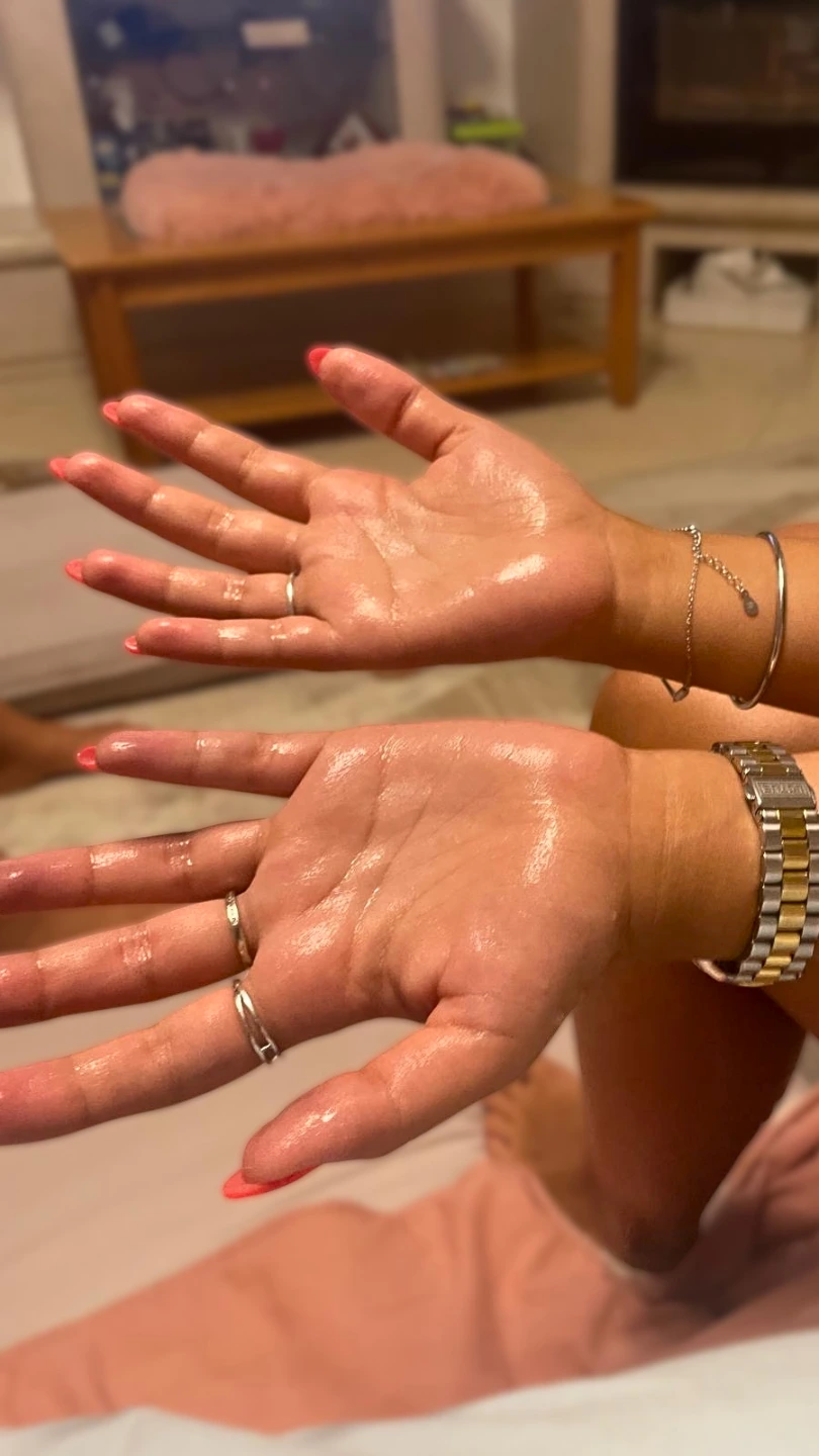 Sweaty palms caused by palmar hyperhidrosis before Hidroxa iontophoresis treatment