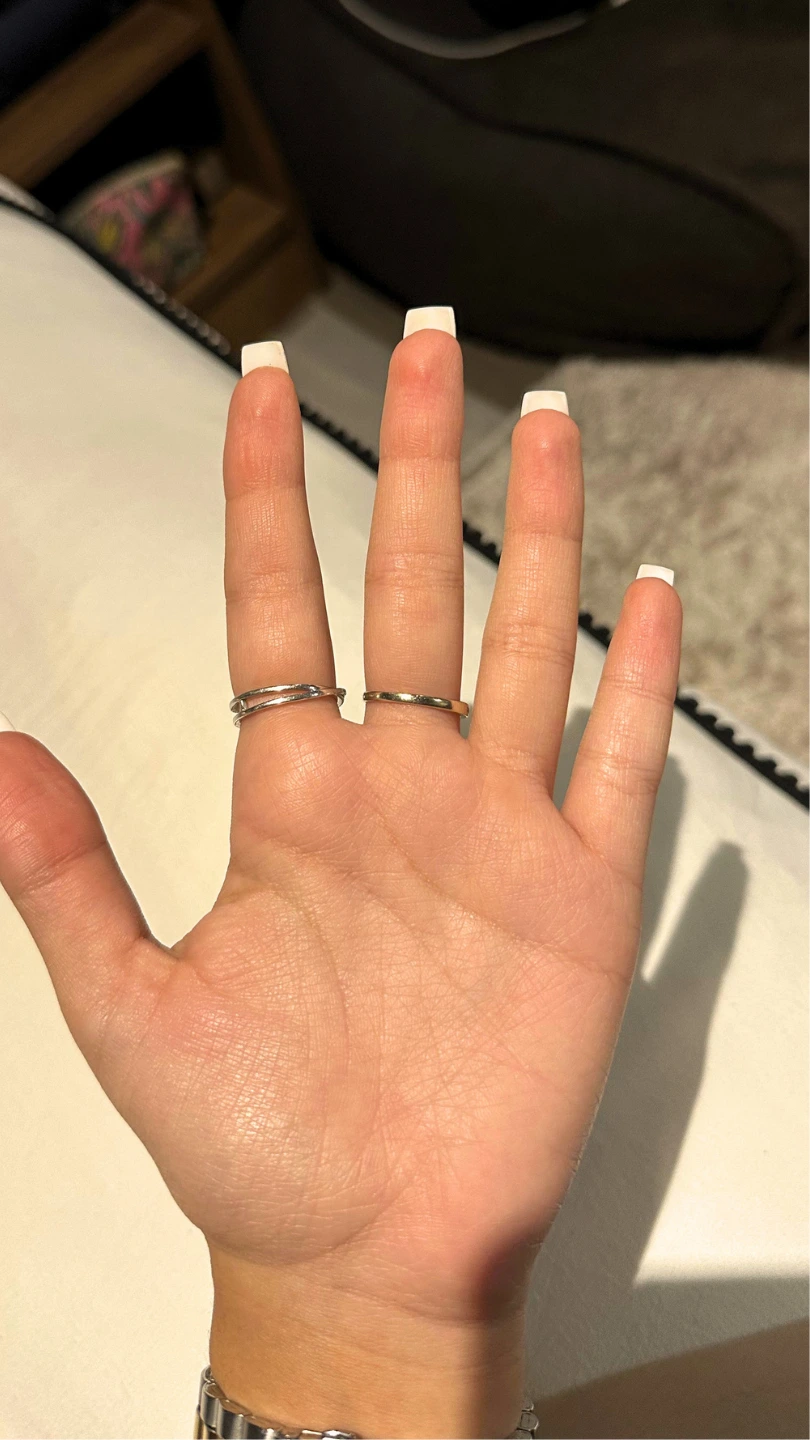 Dry palms after Hidroxa iontophoresis treatment for palmar hyperhidrosis