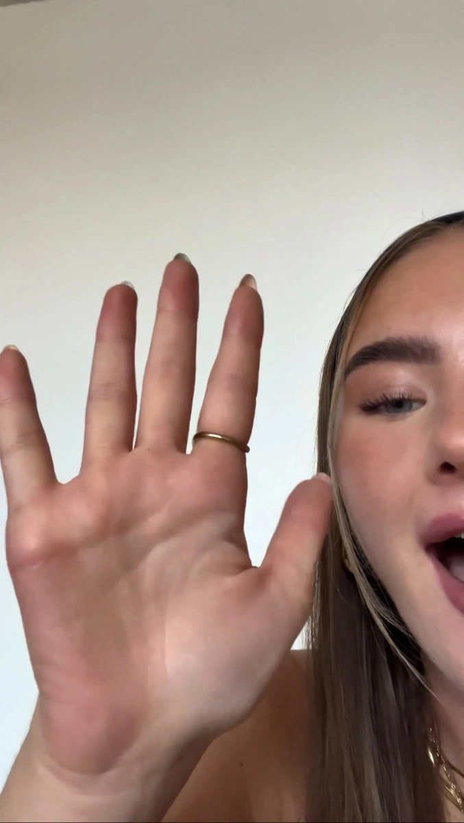Palmar hyperhidrosis hands completely dry after Hidroxa iontophoresis treatment