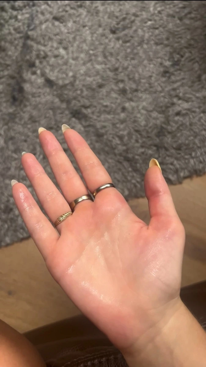 Palmar hyperhidrosis hands with excessive sweating before Hidroxa iontophoresis treatment
