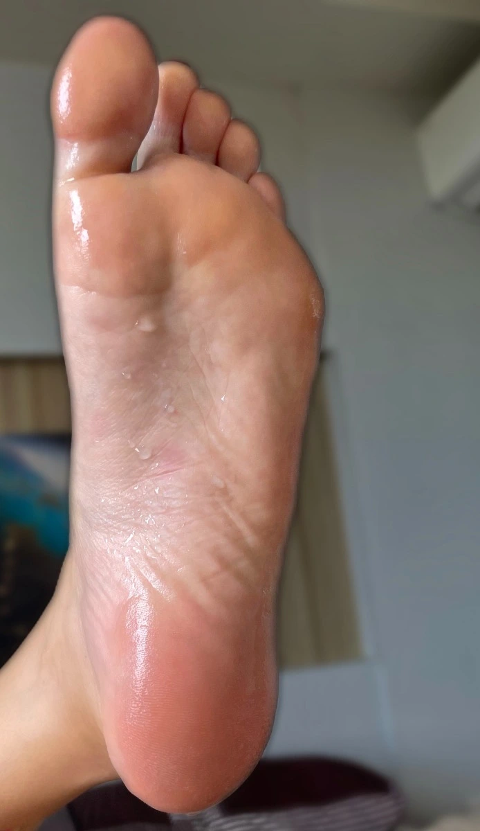 Sweaty foot caused by plantar hyperhidrosis before Hidroxa iontophoresis treatment
